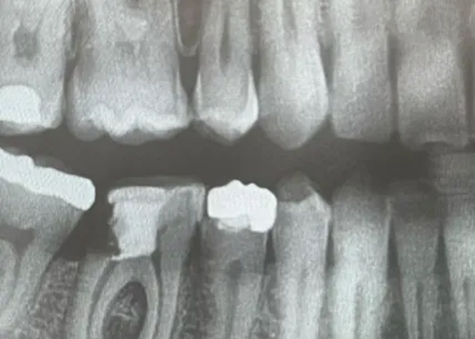 Direktimplantat efter tandutdragning – Så lyckades vi i ett svårt fall tandimplantat Malmö