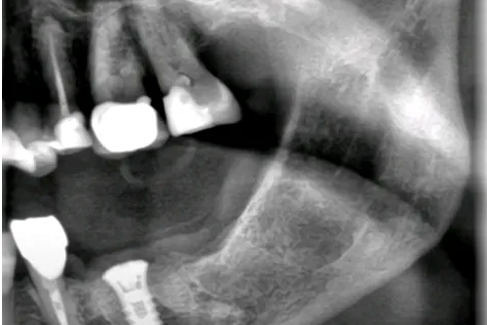 Direktimplantat – när tandimplantat placeras direkt efter tandutdragning tandimplantat Malmö