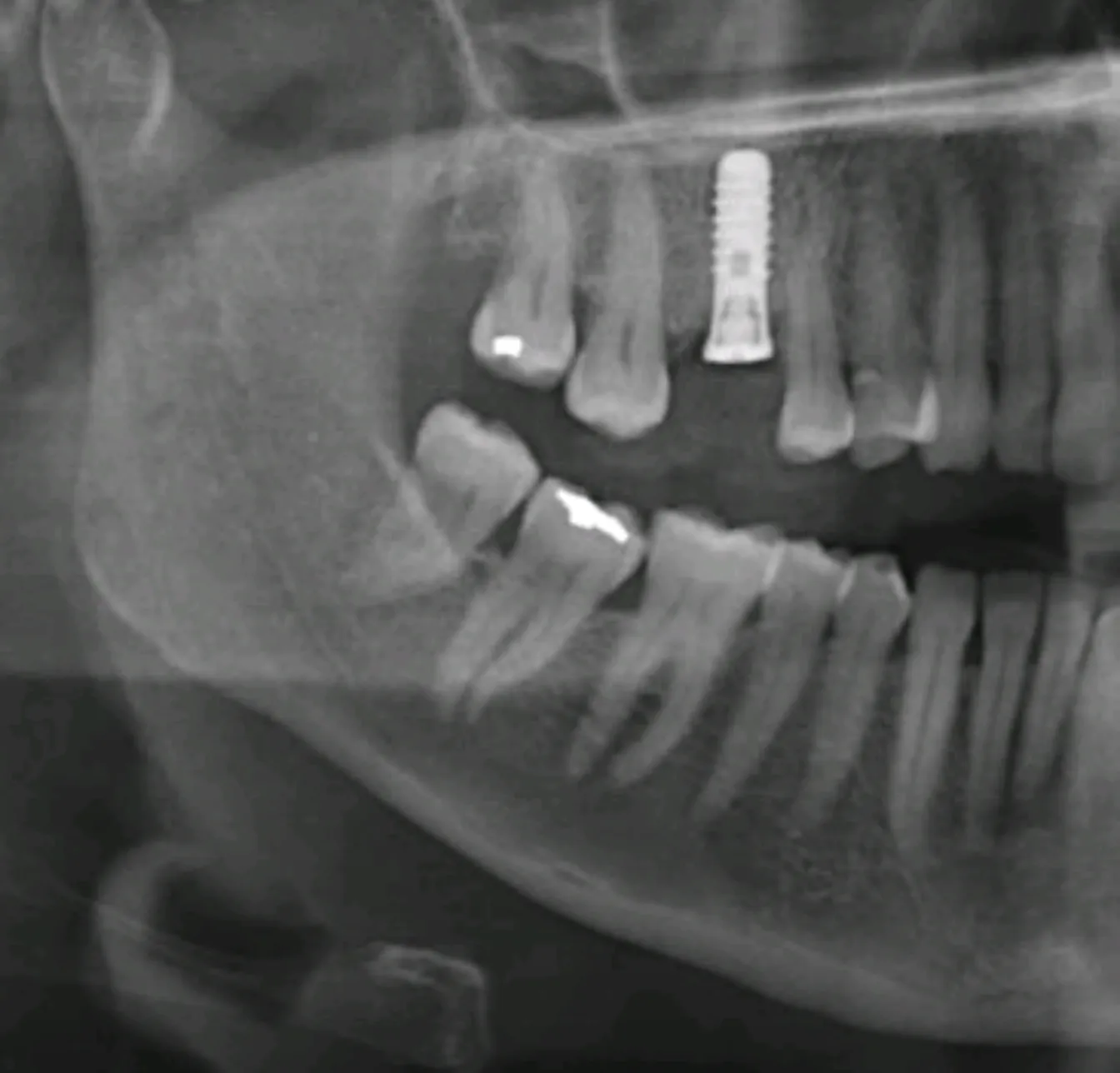 Debridement and Antibacterial Protocols in Immediate Implant Placement tandimplantat Malmö