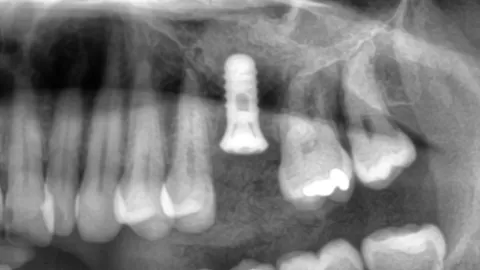 Omedelbar implantatplacering efter tandextraktion – effektiv behandling med bevarad vävnad och förkortad läkningstid