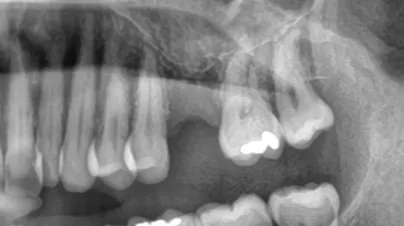 Sinuslyft och Tandimplantat – Så Återställde Vi Benvolymen för en Stabil Implantatbehandling tandimplantat Malmö