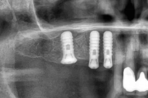 En patientberättelse: Tre direktimplantat i överkäken – trygg och modern tandvård i Malmö tandimplantat Malmö
