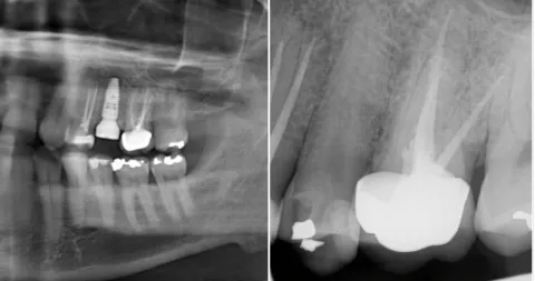Direktimplantat Malmö – Snabb, trygg lösning efter tandutdragning