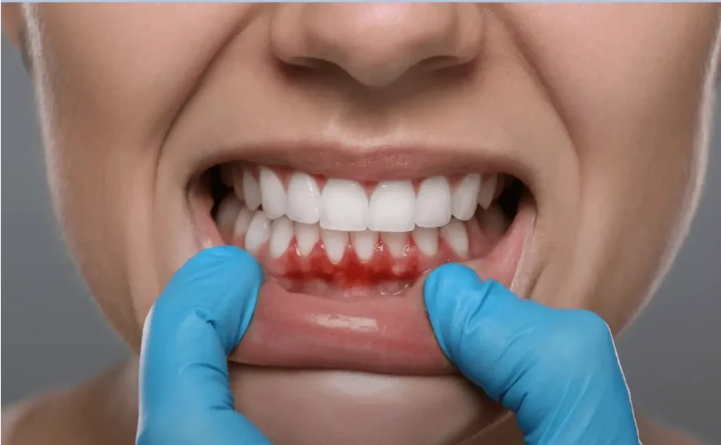 Tandköttet och hjärnan – Hur din munhälsa kan påverka risken för stroke tandimplantat Malmö