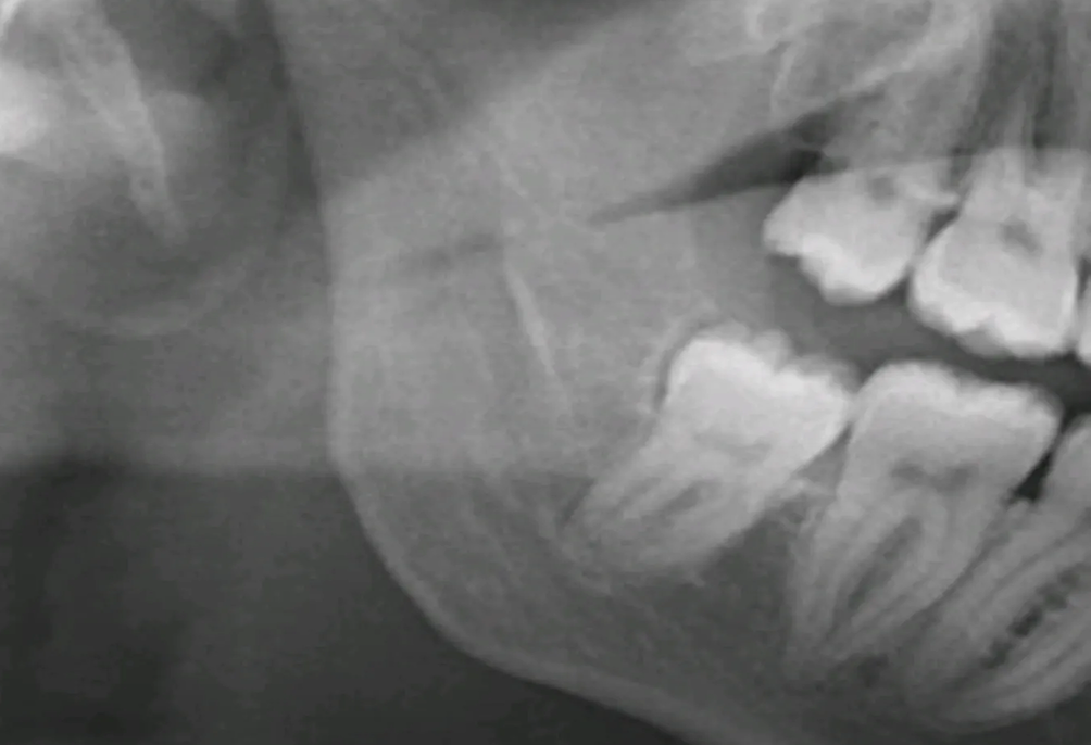 Visdomstandoperation Malmö – Trygg och skonsam käkkirurgi