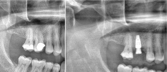 Direktimplantat i överkäken – tandimplantat direkt efter utdragning