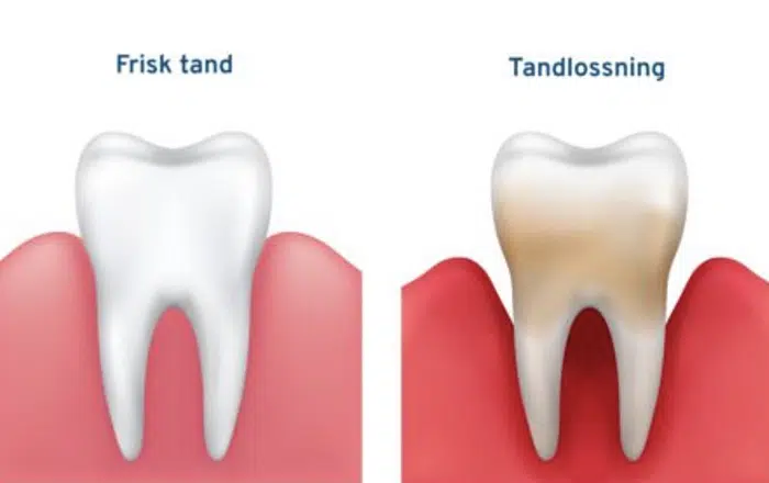 tandlossning