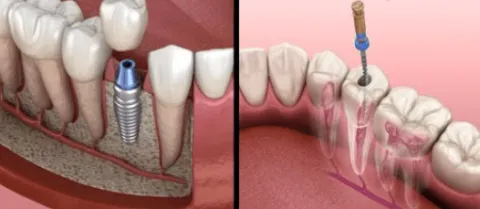 Rotfyllning eller tandimplantat – vad är bäst för dig?