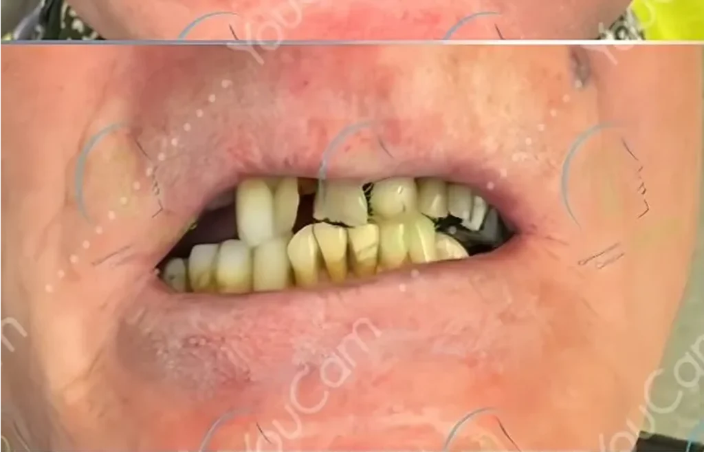 Direkte implantatindsættelse – En moderne løsning efter tandudtrækning