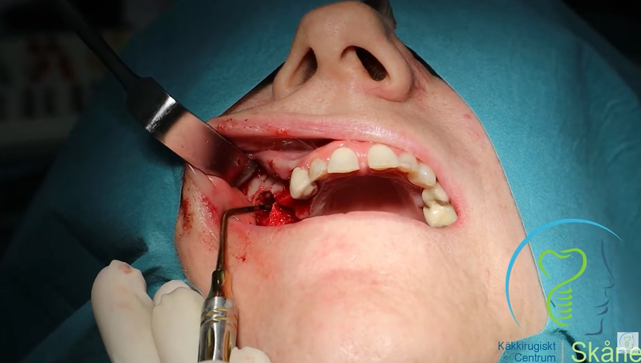 Knogleopbygning kæbe København tandimplantat behandling
