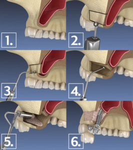 Knogleopbygning kæbe København tandimplantat behandling
