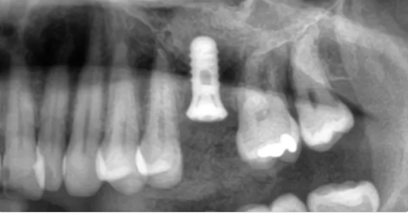 Sinusløft København tandimplantat behandling