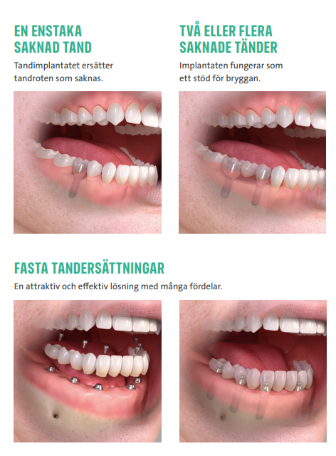 Tandimplantat pris København specialist behandling